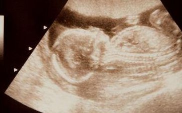 确诊为免疫性不孕能在兴化市做试管婴儿吗？做三代试管需要多少钱？