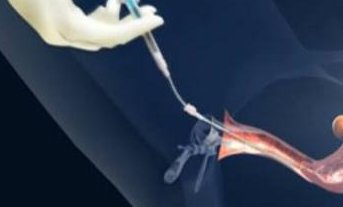 泰国有做试管婴儿不要结婚证的医院吗？